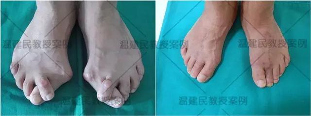 大脚骨怎么做手术好得快,什么样的大脚骨需要手术