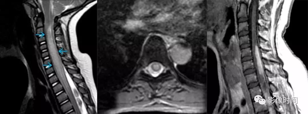 脊髓病变案例图文问诊,脊髓病变视频