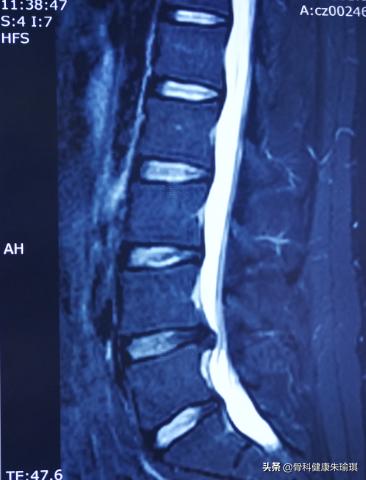 腰椎间盘突出做推拿效果怎么样啊,腰椎间盘4-5节突出的推拿按摩