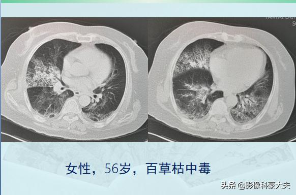 百草枯中毒事件25岁女生,百草枯25岁女孩中毒事件后续
