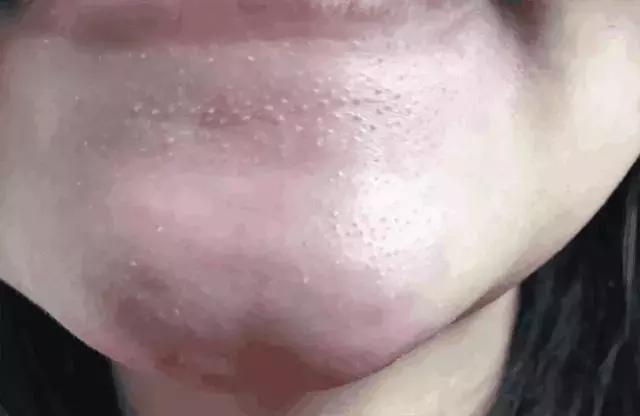 抿嘴时下巴密密麻麻小疙瘩,下巴长了好多凸起来的小疙瘩