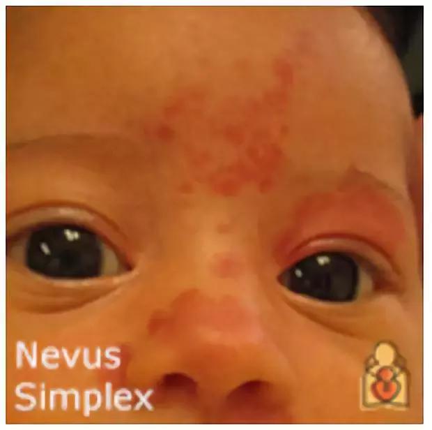 为什么宝宝出生屁股会有青胎记,宝宝出生屁股上有淤青是什么原因