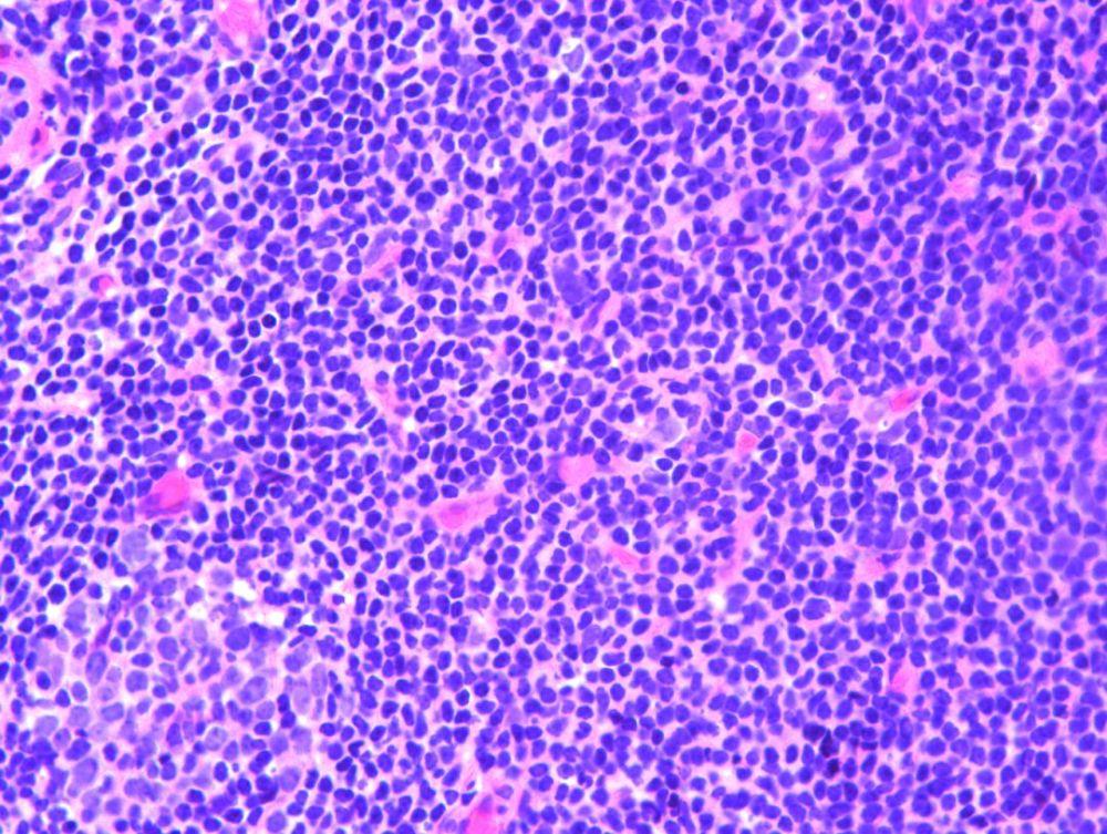 风湿性舞蹈病,一般发生在青春期之前,患者会有脑炎、白喉等症状