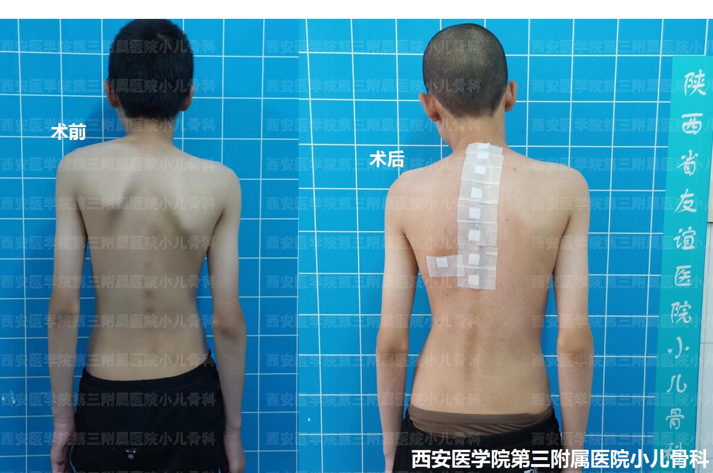 先天性高肩胛手术,先天性肩胛症通过手术需要多少钱