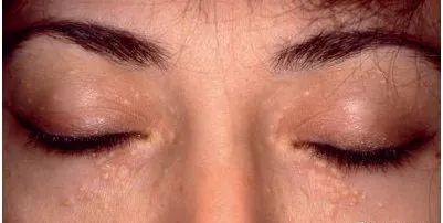 脸上长了闭口小颗粒怎么去除,脸上长白色小颗粒怎样去除掉