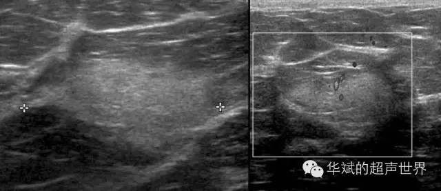 纤维脂肪瘤属于什么类型的疾病,特殊类型脂肪瘤