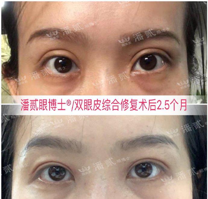 双眼皮改单眼皮案例,扇形双眼皮改平行双眼皮多少钱