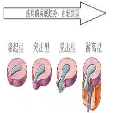 腰突如何治疗才能根治,腰突保守无效别盲目等