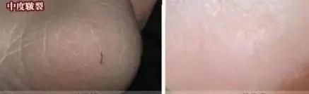 天天洗脚换袜子脚臭怎么办,为啥天天洗脚换袜子穿上鞋脚还臭