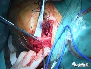 治疗肩锁关节脱位，有最好的方法吗？