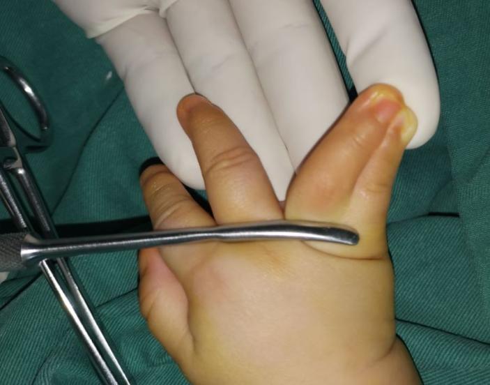 先天性并指畸形科普以及案例分享,先天性并指畸形