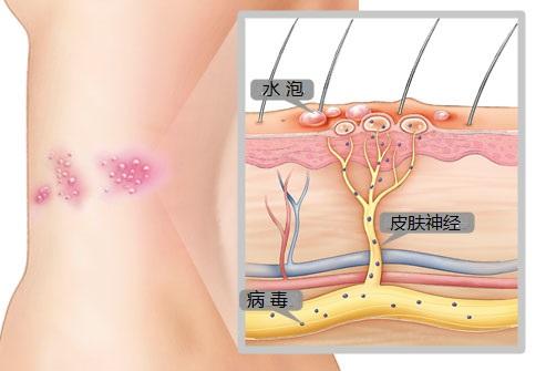 有一种剧痛叫带状疱疹,肋间神经痛与带状疱疹哪个比较痛