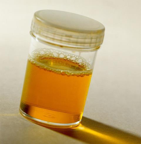 尿里蛋白质是指蛋白尿吗,蛋白尿的含义