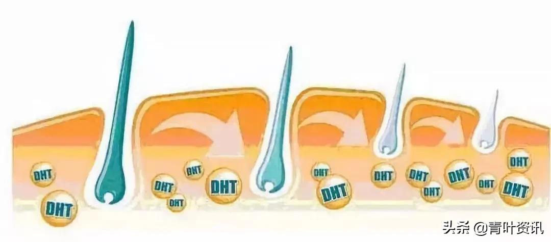 中药治疗遗传性脱发,遗传性脱发怎么治疗
