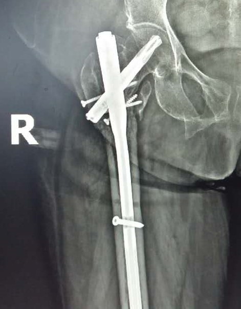 髋部骨折危害大老年人摔伤要重视,髋部骨折的最简单方法