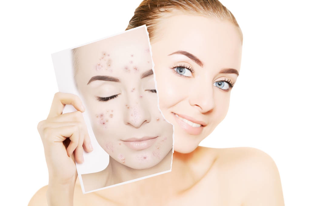 什么好的方法可以祛痘让皮肤变好,怎样祛痘皮肤变好不出油