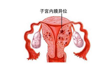 打针假绝经疗法副作用,子宫内膜异位症假绝经疗法