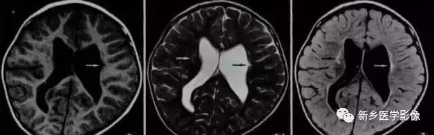 脑室为什么会扩张,脑室为什么会变小