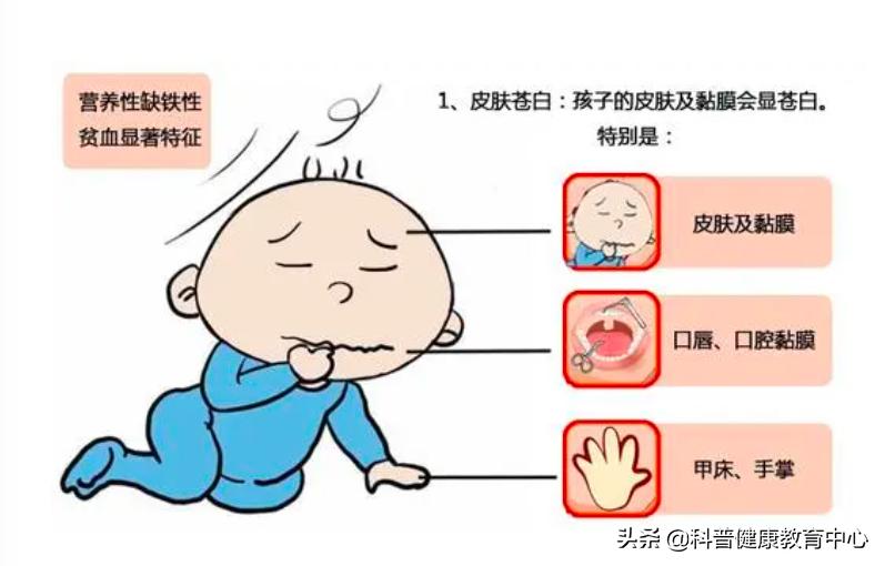 缺铁性贫血临床现状和最新进展,中国缺铁性贫血新闻