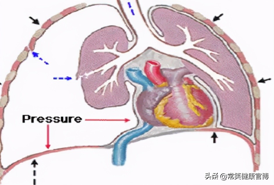 气胸复发隐约有点疼呼吸不受影响,气胸是什么原因造成的呢图文介绍