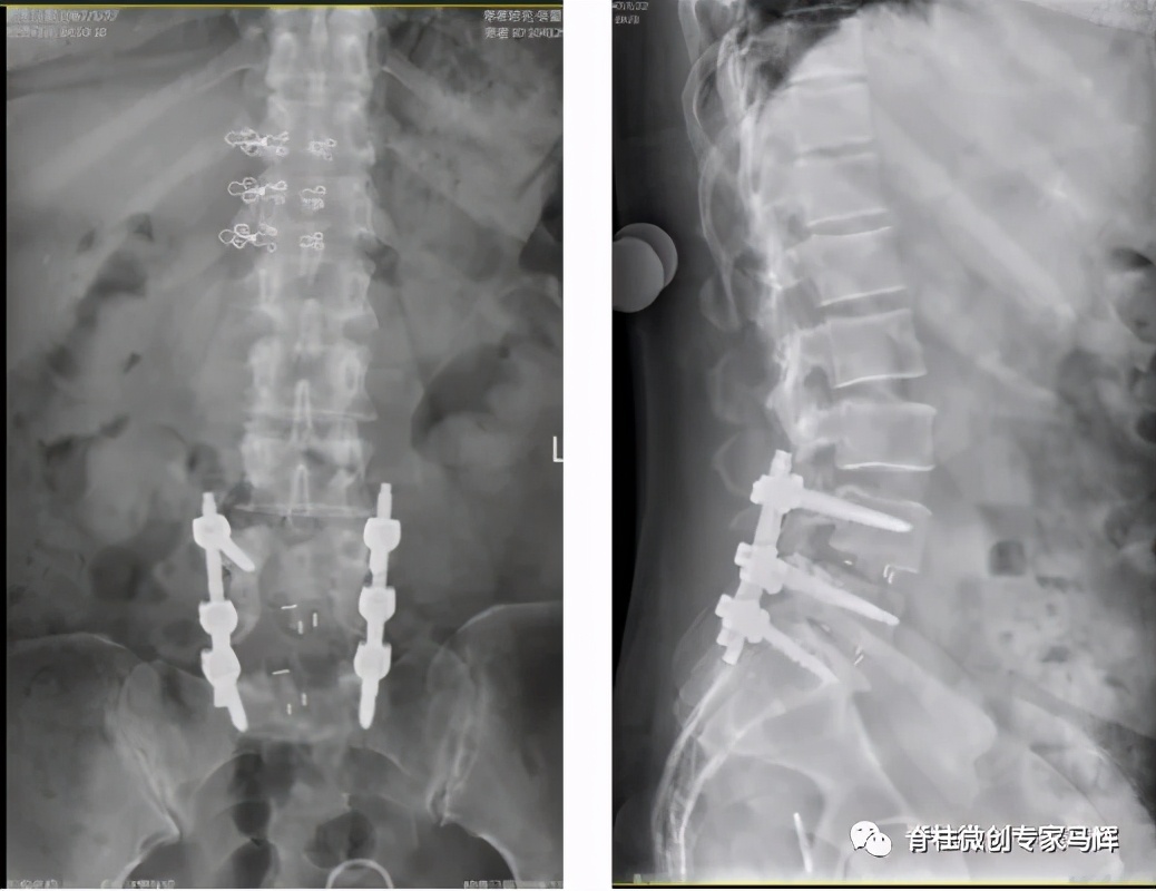 腰椎脓肿会发烧吗,腰间盘突出引起下肢疼痛发烧