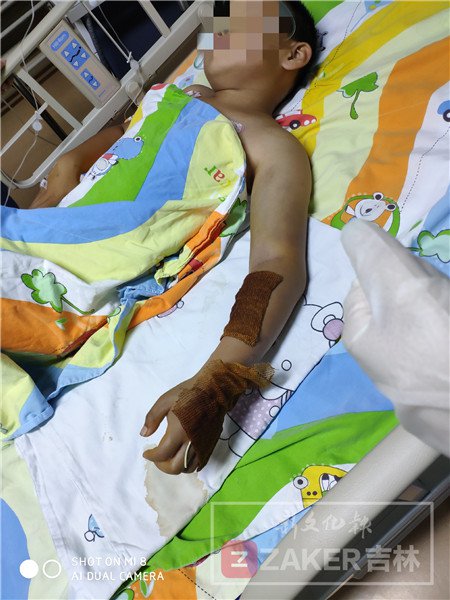 男孩被毒蛇咬伤送医时宁死不说,男孩被毒蛇咬伤中蛇毒