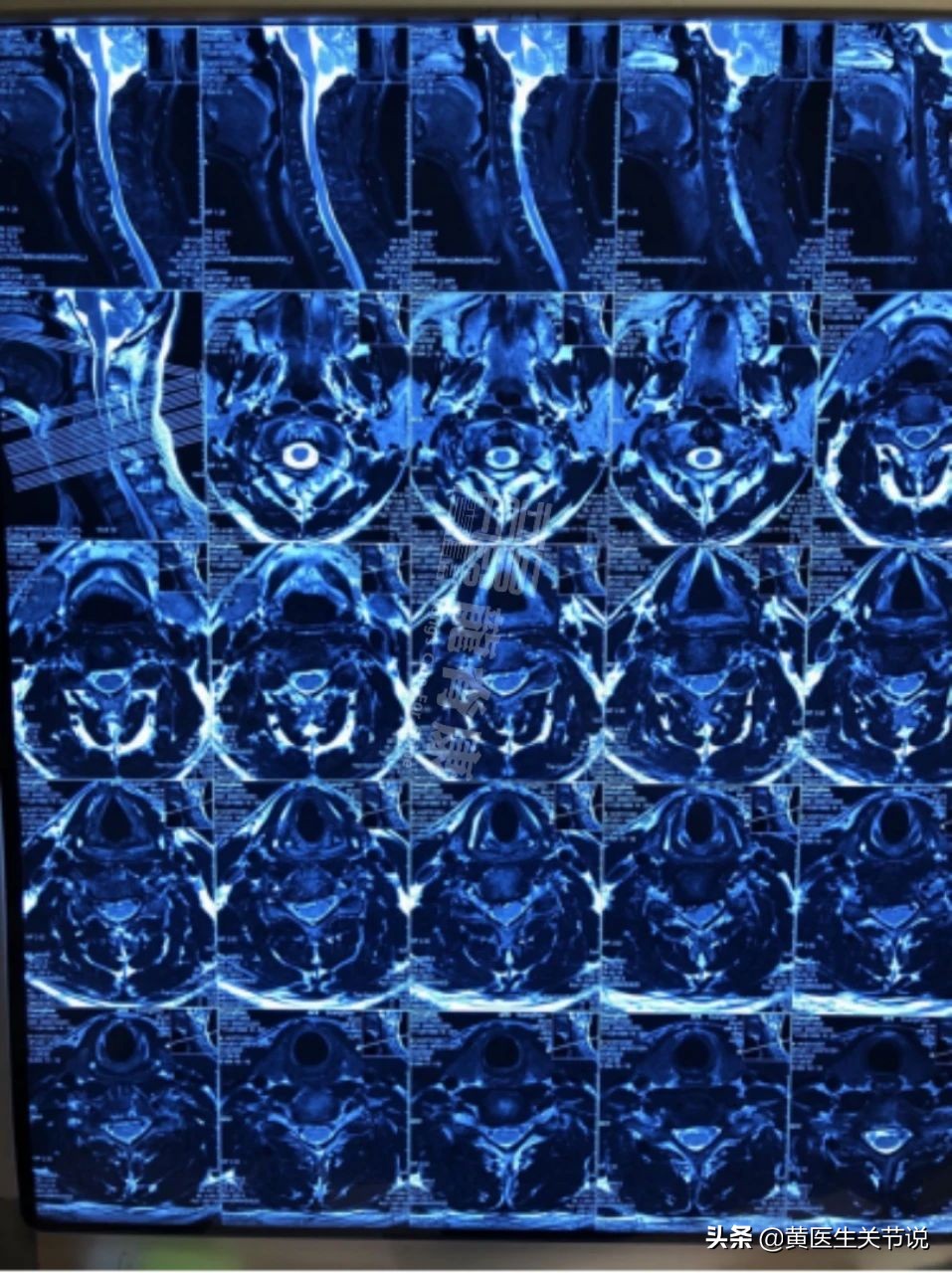 颈椎间盘突出什么情况需要手术,颈椎间盘突出硬膜囊受压手术费用