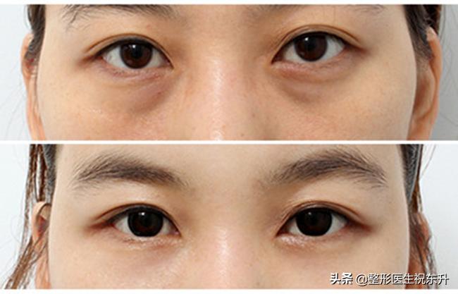 想做眼袋手术做哪种好,去眼袋手术会有疤痕吗