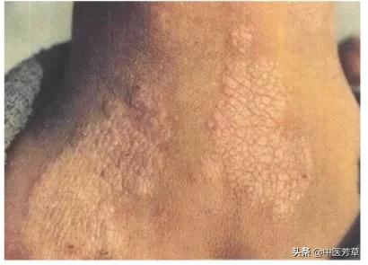 外阴瘙痒神经性皮炎用什么药膏,皮肤瘙痒难忍小心神经性皮炎