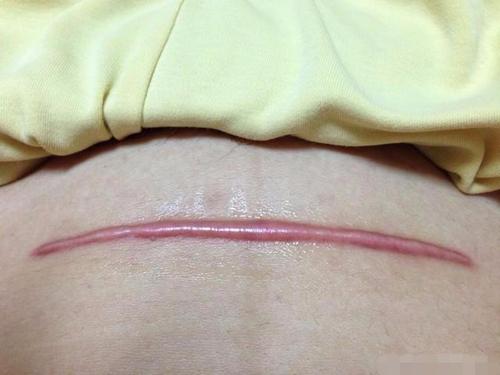 如何防止剖腹产伤疤痒,剖腹产肚皮疤痕