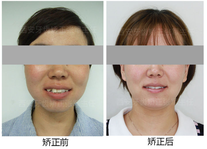 西安透明式牙齿矫正器龅牙,昆明牙齿矫正改变脸型