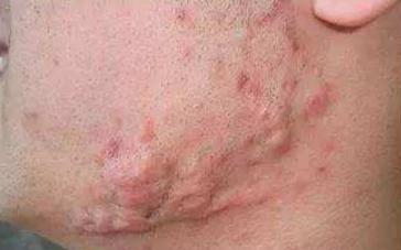 最有效祛痘疤方法,祛痘疤最有效的方法学生