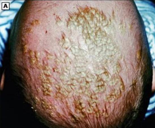 宝宝头垢不清理会有什么后果,婴儿头垢用手抠了咋办