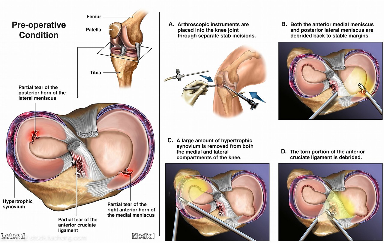 膝关节疼痛有半月板损伤能治好吗,膝盖疼半月板损伤肿胀怎么办