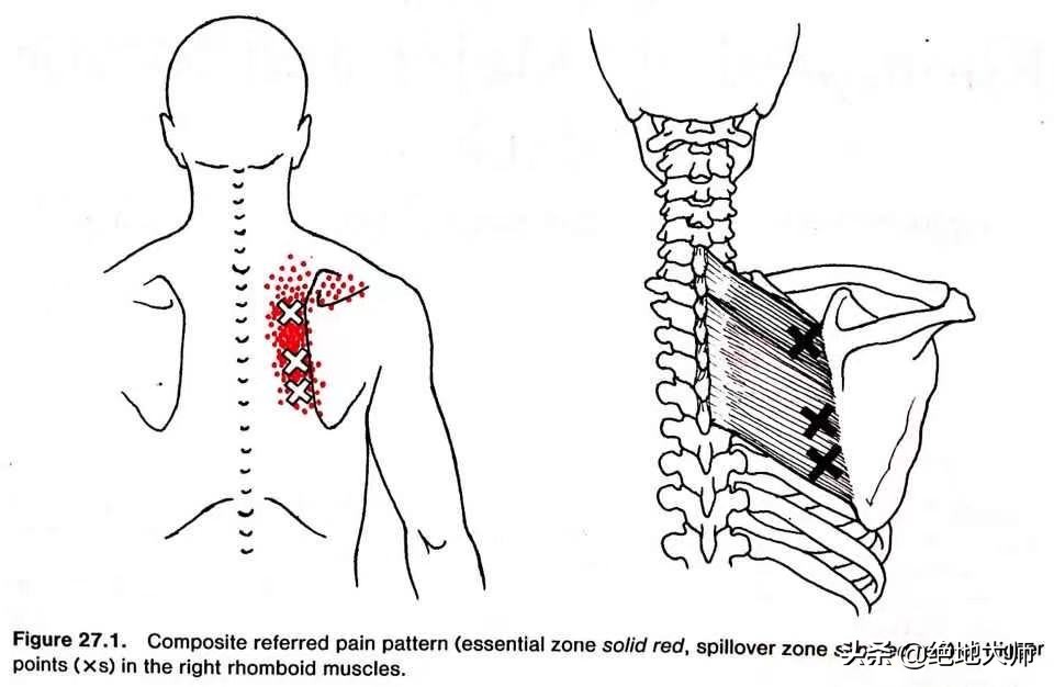 肩胛疼痛为何要做康复,肩胛区疼痛治疗