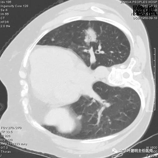 左肺下叶恶性病变,左肺上叶和下叶都有血管畸形