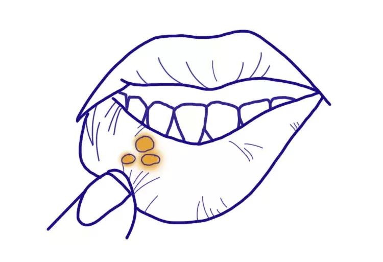 嘴上长了一个巨大的口腔溃疡,嘴皮上长了个口腔溃疡