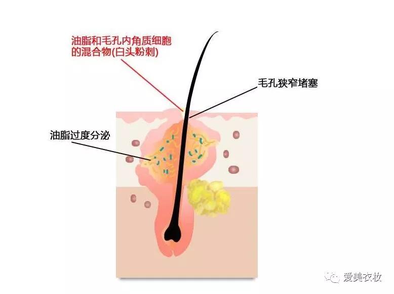 毛孔粗大怎么办怎么有效收缩毛孔,毛孔粗大黑头挤出来怎么缩小毛孔