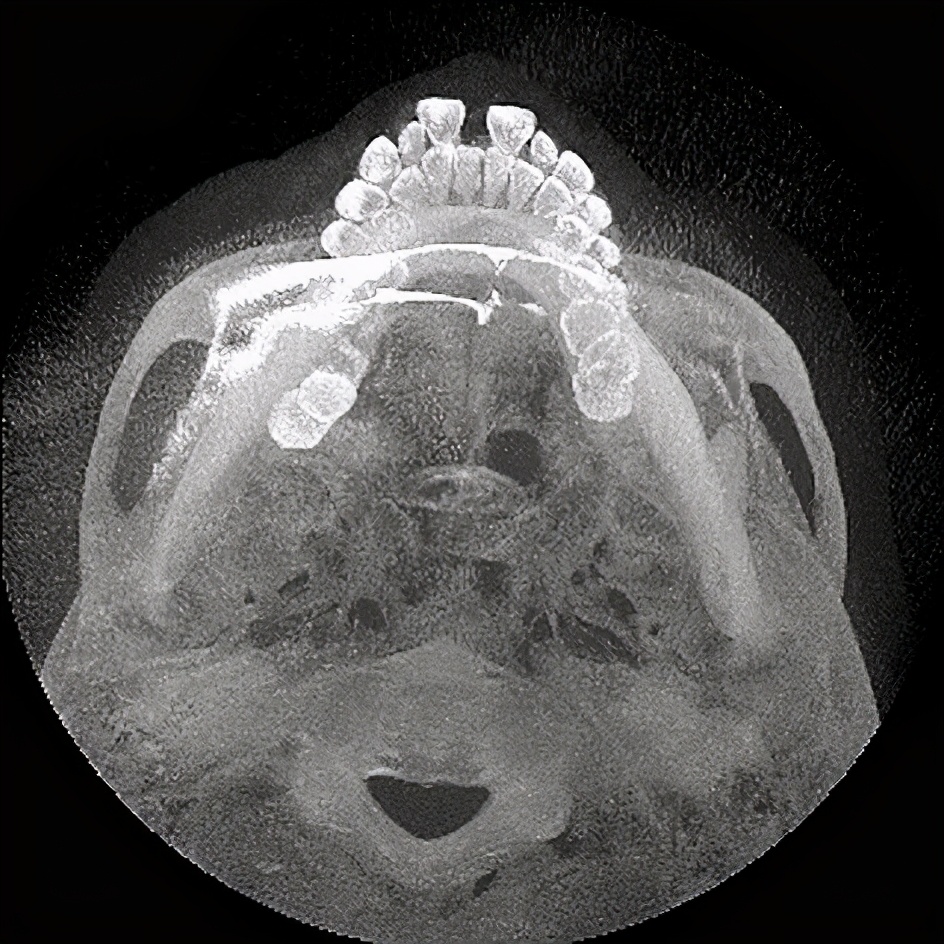 杨磊正畸医生,牙周病牙龈萎缩正畸案例