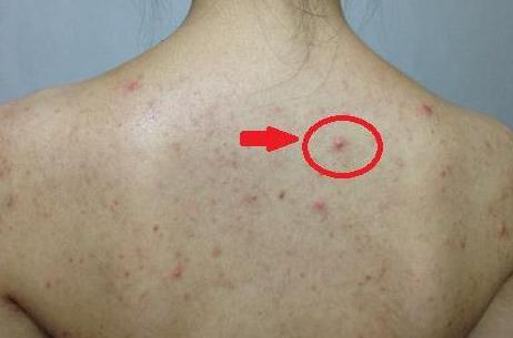 正确消除螨虫的方法,别让螨虫毁了