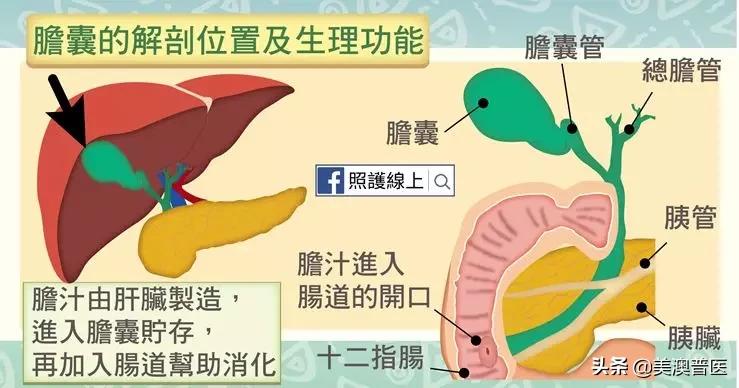 胆结石不治疗会拖成胆囊癌？有几点要特别注意