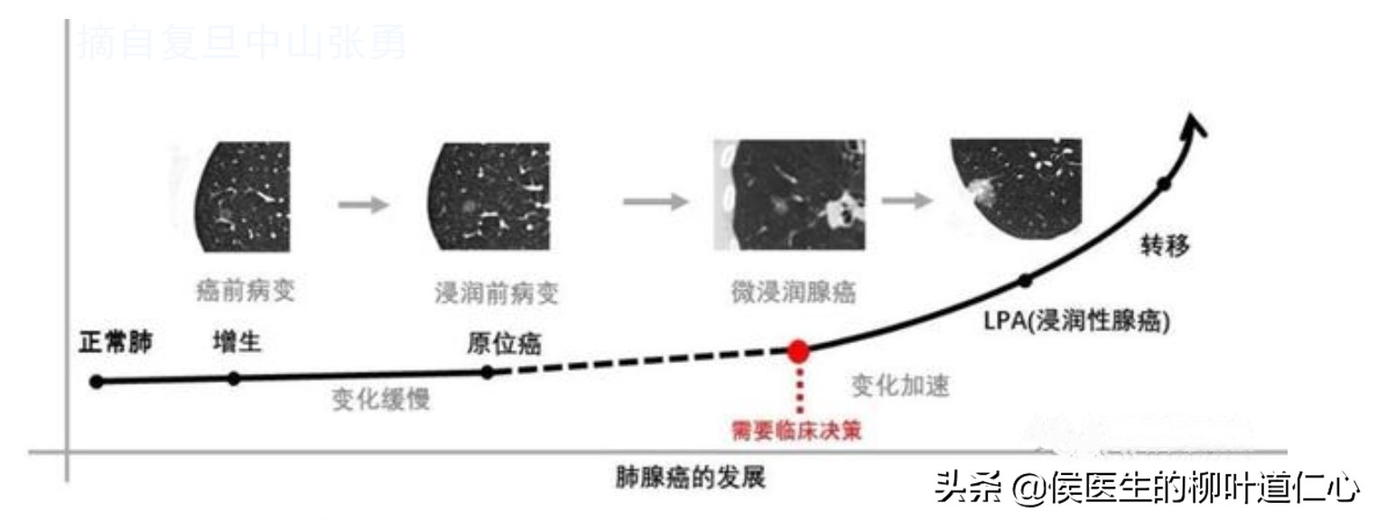 肺结节0.8厘米需手术吗,肺结节0期能治好吗