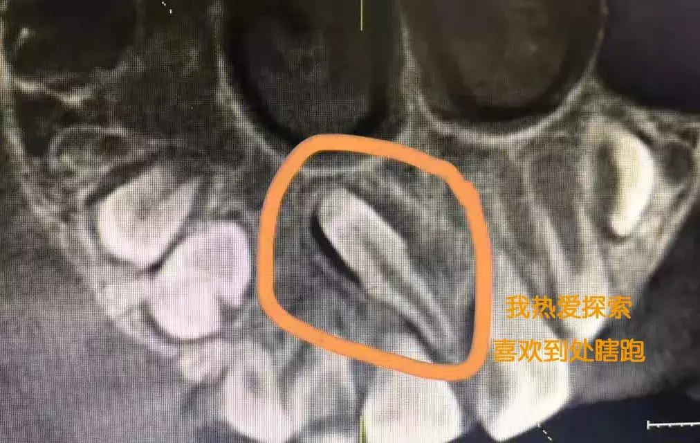 孩子喜欢打闹招惹别人怎么办,儿童埋伏多生牙
