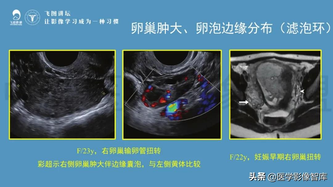 子宫解剖结构输卵管和卵巢位置,子宫附件ct影像学正常解剖表现
