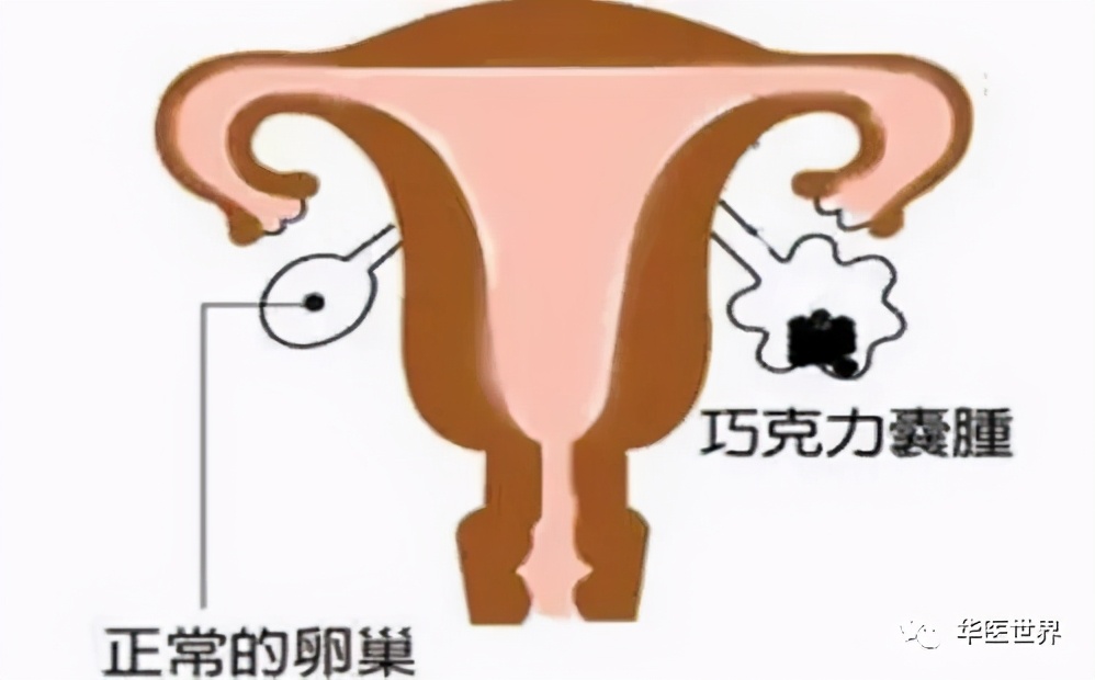 最好的中医治疗卵巢巧克力囊肿,卵巢巧克力囊肿治疗的好方法