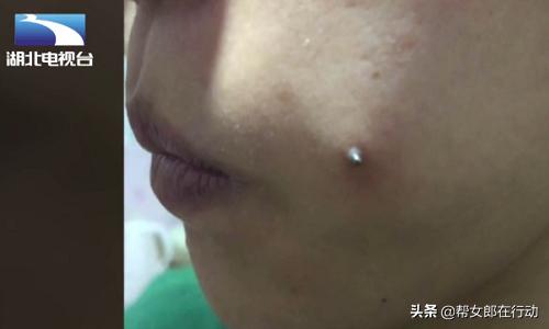 19岁女子打钢钉“种”酒窝，不料遇上庸医，感染发炎差点毁容