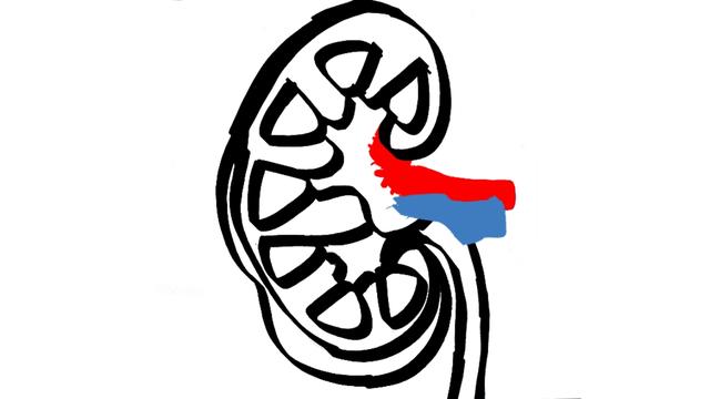 尿路结石发作立马缓解的方法,尿路结石疼怎么快速止痛小妙招