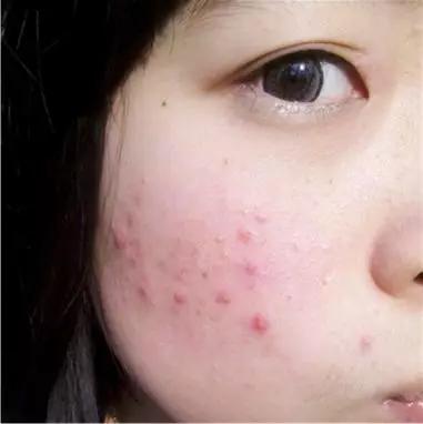 当*疮痤**“上脸”时，如何用乳木果油、非洲黑皂与它“死磕”到底？