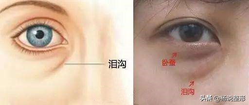 割完眼袋眼肿为什么,割完眼袋显得眼凶