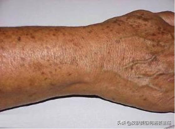 皮肤疣的描述,皮肤疣的中医治疗方法